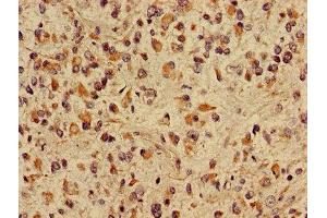 Immunohistochemistry of paraffin-embedded human glioma using ABIN7149048 at dilution of 1:100 (CRIPT 抗体  (AA 1-101))