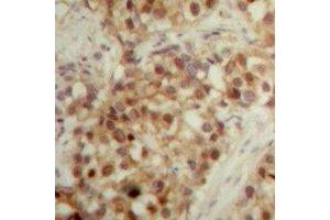 Immunohistochemical analysis of LONP2 staining in human breast cancer formalin fixed paraffin embedded tissue section.