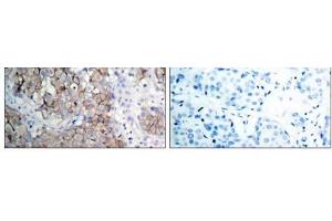 Immunohistochemical analysis of paraffin- embedded human breast carcinoma tissue using IGF-1R (phospho-Tyr1161) antibody (E011087). (IGF1R 抗体  (pTyr1161))