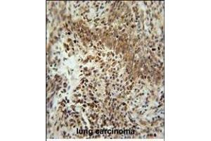 ZN Antibody (Center) (ABIN654509 and ABIN2844236) immunohistochemistry analysis in formalin fixed and paraffin embedded human lung carcinoma followed by peroxidase conjugation of the secondary antibody and DAB staining. (ZNF667 抗体  (AA 303-331))