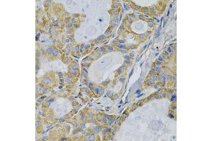 Immunohistochemistry of paraffin-embedded human thyroid cancer using TLR7 Antibody (ABIN1875113) at dilution of 1:100 (40x lens). (TLR7 抗体)