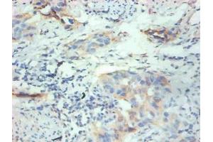Immunohistochemical of paraffin-embedded human breast cancer tissue using ABIN7152614 at dilution of 1:200 (FABP3 抗体)