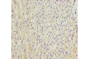 Immunohistochemistry of paraffin-embedded human liver cancer using ABIN7149264 at dilution of 1:100 (CYP3A4 抗体  (AA 244-503))
