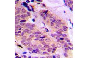 Immunohistochemical analysis of ABCD4 staining in human breast cancer formalin fixed paraffin embedded tissue section. (ABCD4 抗体  (Center))