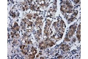 Immunohistochemical staining of paraffin-embedded Carcinoma of liver tissue using anti-LIPG mouse monoclonal antibody. (LIPG 抗体)