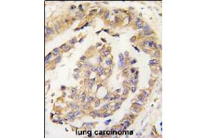 Formalin-fixed and paraffin-embedded human lung carcinoma tissue reacted with Olfm1 Antibody , which was peroxidase-conjugated to the secondary antibody, followed by DAB staining. (Olfactomedin 1 抗体  (N-Term))