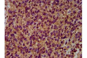 IHC image of ABIN7151037 diluted at 1:500 and staining in paraffin-embedded human glioma performed on a Leica BondTM system. (HECW2 抗体  (AA 495-641))