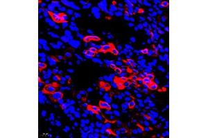Immunofluorescent analysis of paraffin embedded human ovarian cancer using CK6 (ABIN7074423) at dilution of 1: 2000 (Keratin 6 抗体)