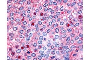Anti-HNF4G / HNF4 Gamma antibody IHC of human Breast, Carcinoma. (HNF4 gamma 抗体  (Ligand Binding Domain))