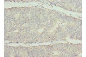 Immunohistochemistry of paraffin-embedded human endometrial cancer using ABIN7174024 at dilution of 1:100 (FRK 抗体  (AA 1-220))