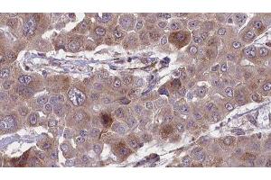 ABIN6276422 at 1/100 staining Human liver cancer tissue by IHC-P. (CEACAM5 抗体  (Internal Region))