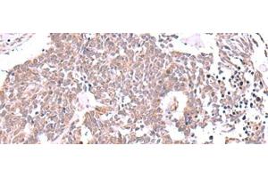 Immunohistochemistry of paraffin-embedded Human lung cancer tissue using JDP2 Polyclonal Antibody at dilution of 1:40(x200) (JDP2 抗体)