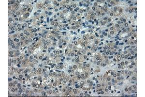 Immunohistochemical staining of paraffin-embedded Carcinoma of thyroid tissue using anti-CRYABmouse monoclonal antibody. (CRYAB 抗体)