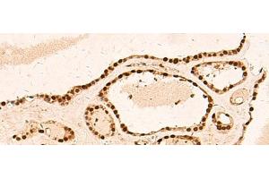 Immunohistochemistry of paraffin-embedded Human thyroid cancer tissue using METTL1 Polyclonal Antibody at dilution of 1:50(x200) (METTL1 抗体)