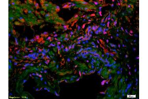 Formalin-fixed and paraffin-embedded human colon carcinoma labeled with Anti-VE Cadherin/VECD/CD144 Polyclonal Antibody, Unconjugated (ABIN1387250) 1:200, overnight at 4°C, The secondary antibody was Goat Anti-Rabbit IgG, Cy3 conjugated used at 1:200 dilution for 40 minutes at 37°C. (Cadherin 5 抗体  (AA 251-320))