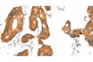 Immunohistochemistry of paraffin-embedded Human colon cancer tissue using ACOX1 Polyclonal Antibody at dilution 1:40 (ACOX1 抗体)
