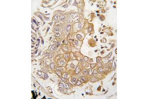 Formalin-fixed and paraffin-embedded human lung carcinoma tissue reacted with CYP1A1 antibody , which was peroxidase-conjugated to the secondary antibody, followed by DAB staining.