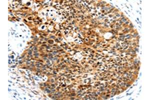 The image on the left is immunohistochemistry of paraffin-embedded Human esophagus cancer tissue using ABIN7191028(HUNK Antibody) at dilution 1/35, on the right is treated with synthetic peptide. (HUNK 抗体)