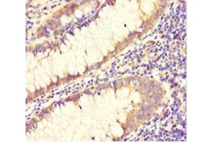 Immunohistochemistry of paraffin-embedded human colon cancer using ABIN7150029 at dilution of 1:100 (DAAM2 抗体  (AA 1-101))