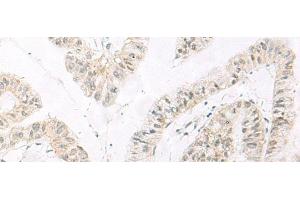 Immunohistochemistry of paraffin-embedded Human liver cancer tissue using HABP4 Polyclonal Antibody at dilution of 1:60(x200) (HABP4 抗体)