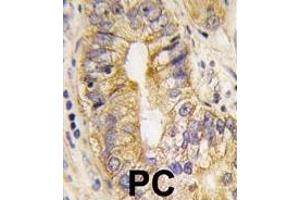 Formalin-fixed and paraffin-embedded human prostata carcinoma tissue reacted with PDGFRA Antibody , which was peroxidase-conjugated to the secondary antibody, followed by DAB staining. (PDGFRA 抗体  (AA 746-775))