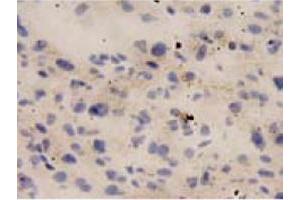 Immunohistochemical staining of human liver cancer tissue section with IL18 monoclonal antibody, clone 2  at 1:10 dilution. (IL-18 抗体)