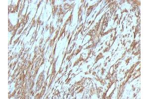 Formalin-fixed, paraffin-embedded human Leiomyosarcoma stained with Muscle Specific Actin Mouse Monoclonal Antibody (MSA/953). (ACTA1/ACTA2A/ACTG2 抗体)
