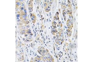Immunohistochemistry of paraffin-embedded human liver cancer using VAPB Antibody (ABIN5973099) at dilution of 1/200 (40x lens). (VAPB 抗体)