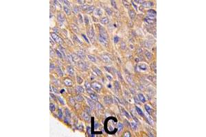 Formalin-fixed and paraffin-embedded human lung carcinoma tissue reacted with TOB2 polyclonal antibody  , which was peroxidase-conjugated to the secondary antibody, followed by DAB staining. (TOB2 抗体  (N-Term))