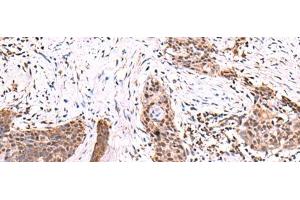 Immunohistochemistry of paraffin-embedded Human esophagus cancer tissue using SCCPDH Polyclonal Antibody at dilution of 1:85(x200) (SCCPDH 抗体)