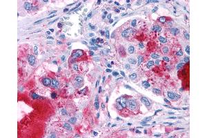 Anti-GPR82 antibody IHC of human Lung, Adenocarcinoma. (GPR82 抗体  (Cytoplasmic Domain))