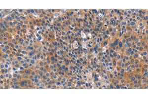 Immunohistochemistry of paraffin-embedded Human liver cancer tissue using ARRB1 Polyclonal Antibody at dilution 1:50 (beta Arrestin 1 抗体)