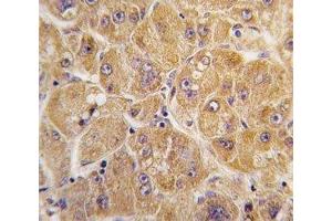 IHC analysis of FFPE human hepatocarcinoma tissue stained with ALDH1A1 antibody (ALDH1A1 抗体  (AA 302-331))