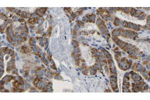 ABIN6267160 at 1/100 staining Human thyroid cancer tissue by IHC-P. (PRAS40 抗体  (pSer183))