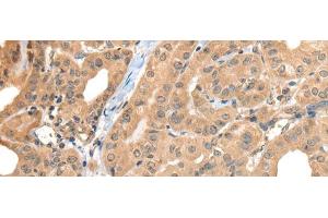 Immunohistochemistry of paraffin-embedded Human thyroid cancer tissue using CA7 Polyclonal Antibody at dilution of 1:50(x200) (CA7 抗体)