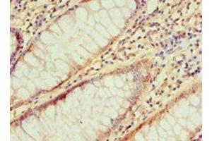 Immunohistochemistry of paraffin-embedded human colon cancer using ABIN7156754 at dilution of 1:100