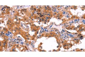 Immunohistochemistry of paraffin-embedded Human thyroid cancer using ERAS Polyclonal Antibody at dilution of 1:40 (ERAS 抗体)