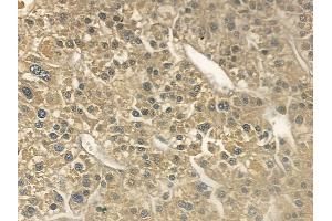 ABIN6263984 and ABIN6269394 at 1/100 staining human hepatocellular carcinoma by IHC-P.