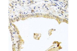 Immunohistochemistry of paraffin-embedded Human lung cancer using PRKCA Polyclonal Antibody at dilution of 1:100 (40x lens). (PKC alpha 抗体)