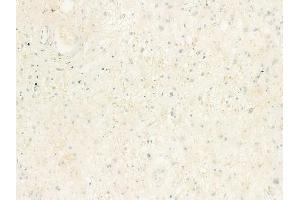 ABIN6263421 and ABIN6273057 at 1/100 staining human astrocytoma by IHC-P. (MTHFD2 抗体  (N-Term))