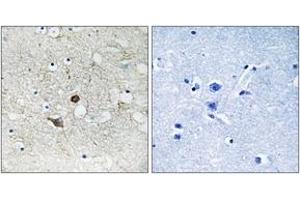Immunohistochemistry analysis of paraffin-embedded human lung carcinoma tissue, using Caspase 2 (Ab-157) Antibody.
