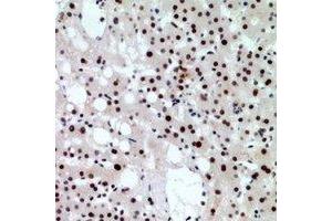 Immunohistochemical analysis of CHD4 staining in human liver cancer formalin fixed paraffin embedded tissue section. (CHD4 抗体)