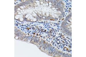 Immunohistochemistry of paraffin-embedded human colon carcinoma using STING antibody (ABIN7270958) at dilution of 1:25 (40x lens). (STING/TMEM173 抗体)