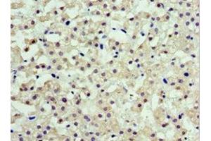Immunohistochemistry of paraffin-embedded human liver cancer using ABIN7143462 at dilution of 1:100 (ARFGAP3 抗体  (AA 217-516))