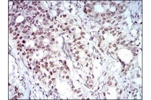Immunohistochemical analysis of paraffin-embedded human cervical cancer tissues using MAPK7 mouse mAb with DAB staining. (MAPK7 抗体  (AA 411-556))