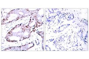 Immunohistochemical analysis of paraffin- embedded human breast carcinoma tissue using c-Jun (Ab-73) antibody (E021003). (C-JUN 抗体)
