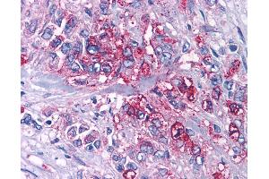 Anti-P2RY4 / P2Y4 antibody IHC of human Pancreas, Carcinoma. (P2RY4 抗体  (Cytoplasmic Domain))