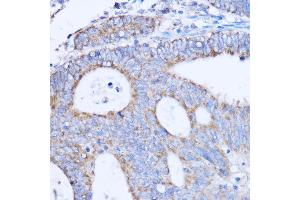 Immunohistochemistry of paraffin-embedded human colon carcinoma using MT-ND3 antibody (ABIN7268601) at dilution of 1:100 (40x lens).