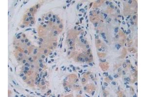 Detection of GHRH in Human Stomach cancer Tissue using Monoclonal Antibody to Growth Hormone Releasing Hormone (GHRH) (GHRH 抗体  (AA 19-108))