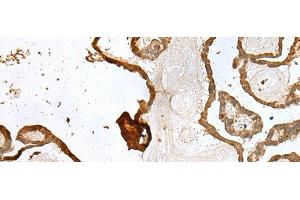 Immunohistochemistry of paraffin-embedded Human thyroid cancer tissue using UBE2Z Polyclonal Antibody at dilution of 1:35(x200) (UBE2Z 抗体)